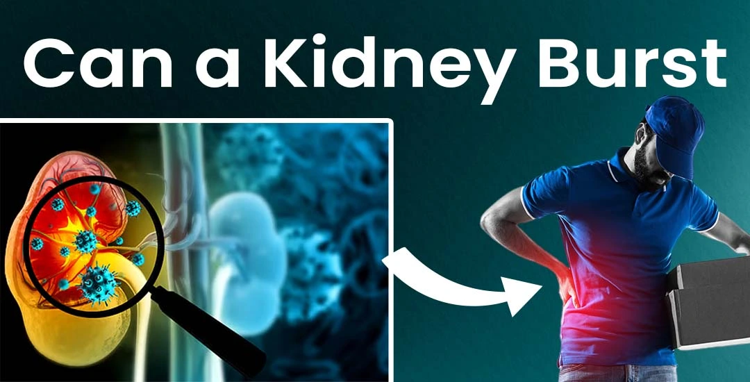 Can a Kidney Really Burst? Warning Signs You Shouldn’t Ignore